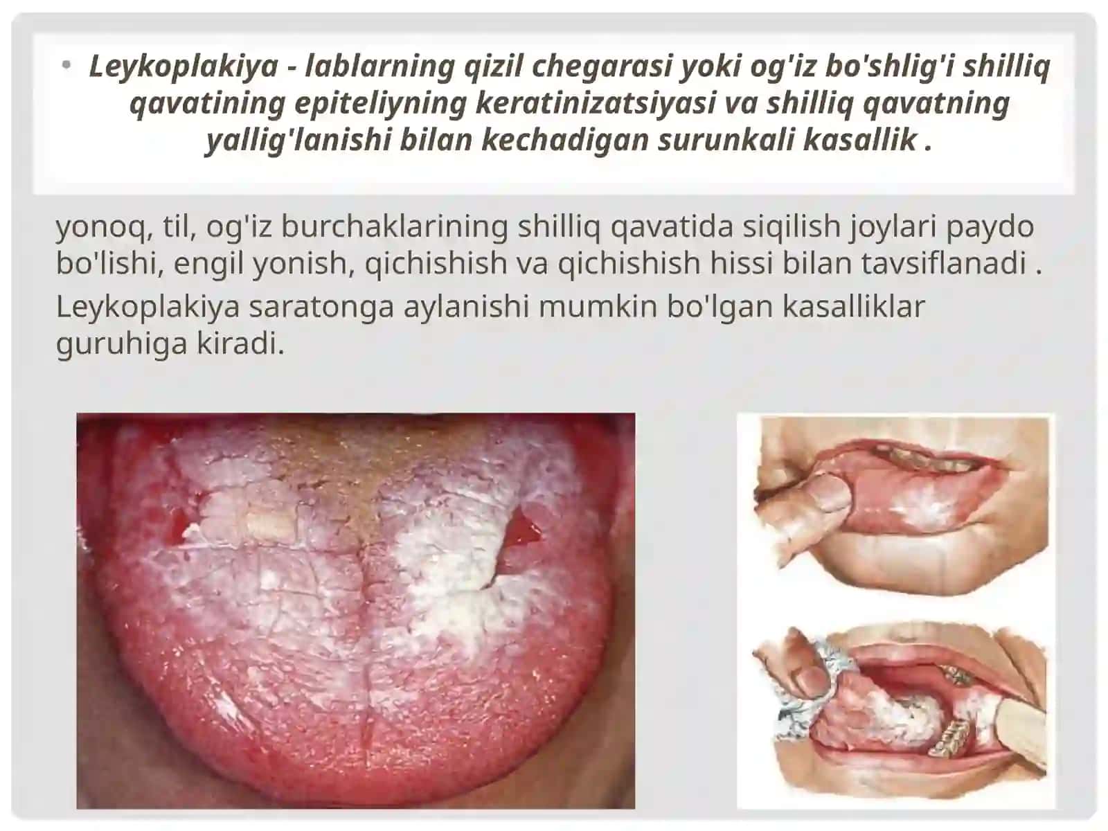 Leykoplakiya. Shakllar. Etiologiya. Davolash. 2