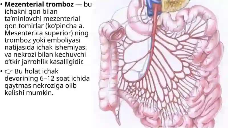 Mezenterial tromboz 2