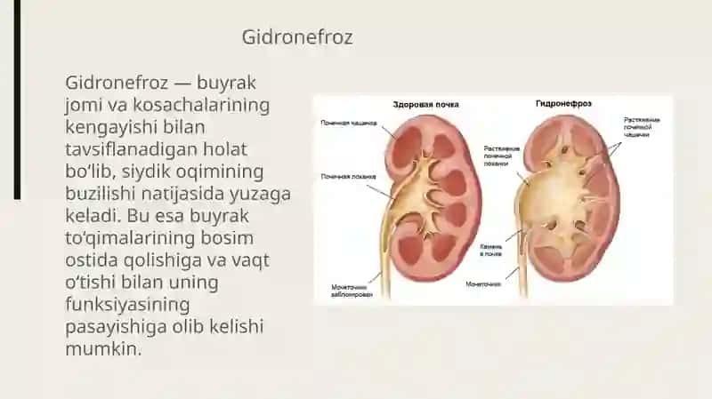 Gidronefroz 2