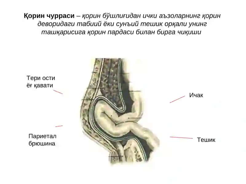 Қоринолди девори тўғри мушаклар диатези 2