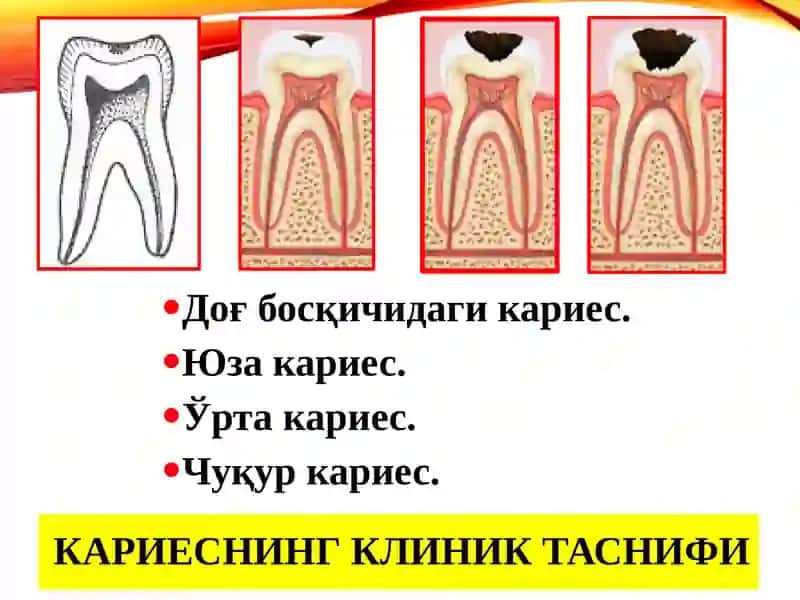 Тиш кариесини даволаш усули 2