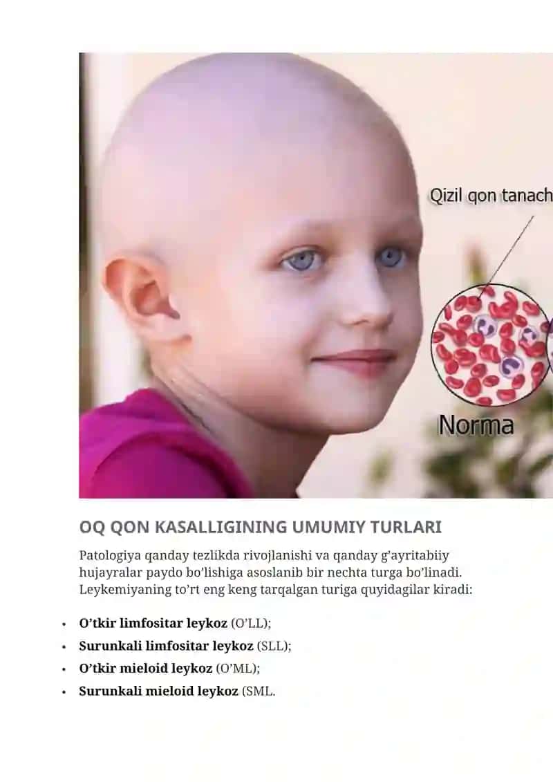 OQ QON KASALLIGI (LEYKEMIYA) 2
