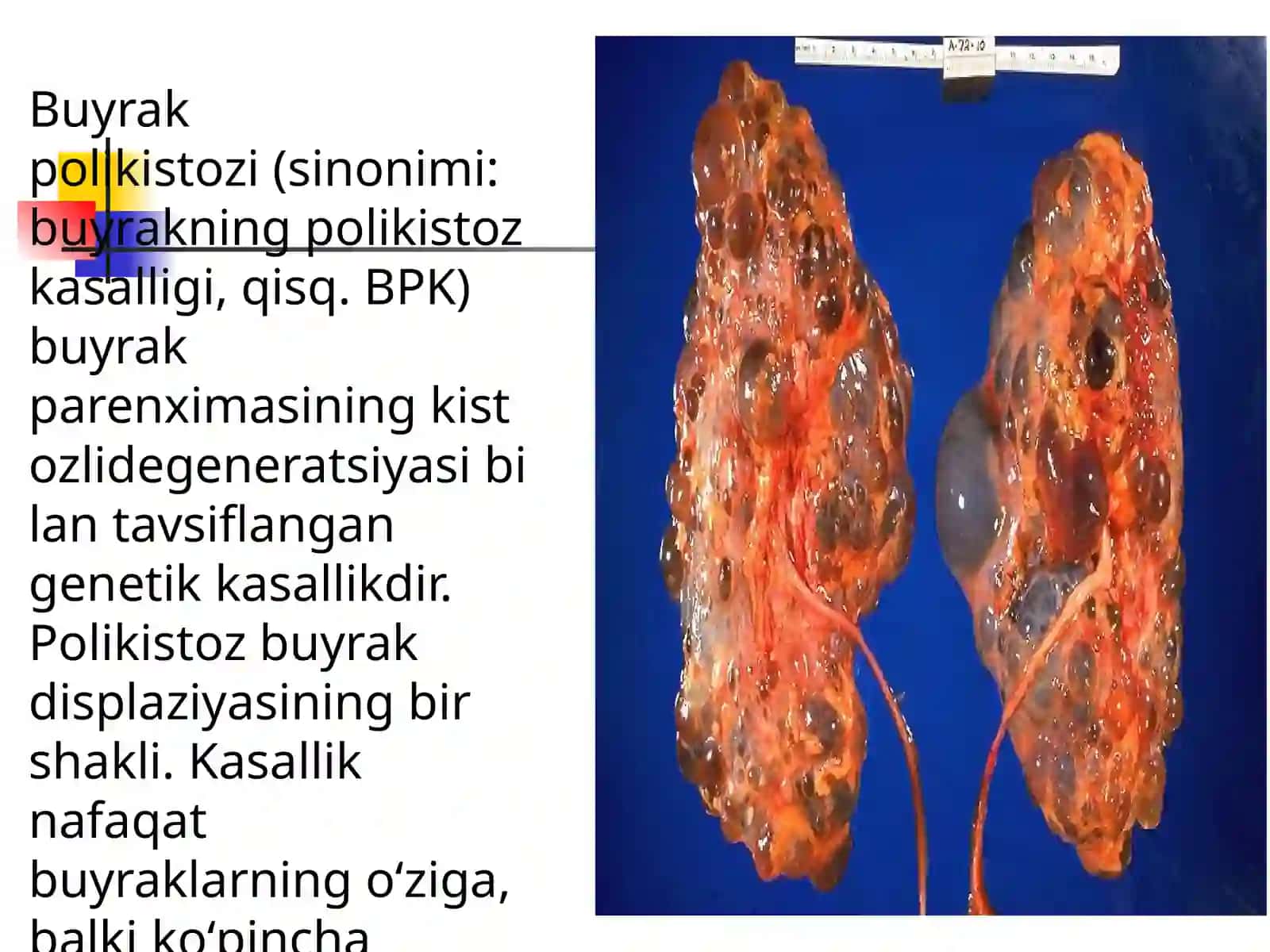 Buyrak polikistozi 2