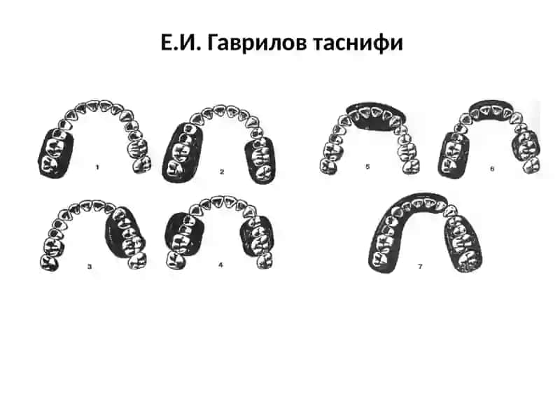 Таянч тишлар билан даволаш 2