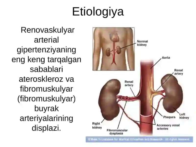 Renovaskulyar gipertenziya 2