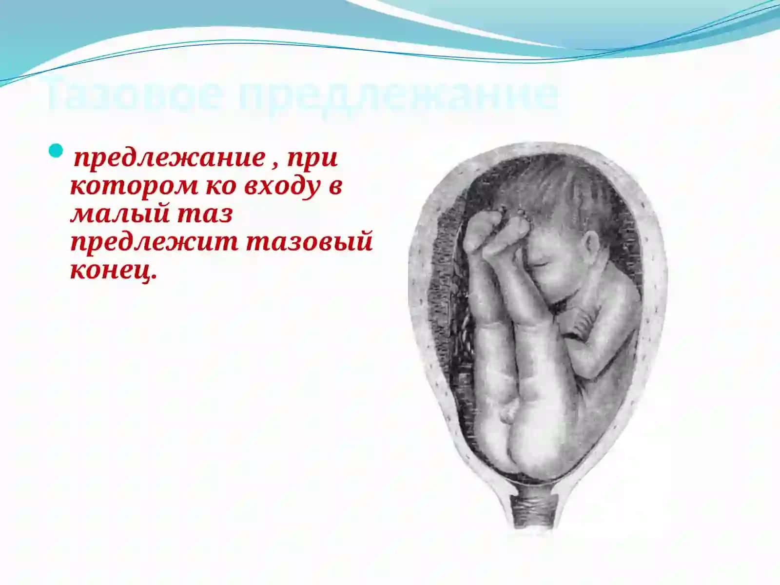 Тазовые предлежания 2