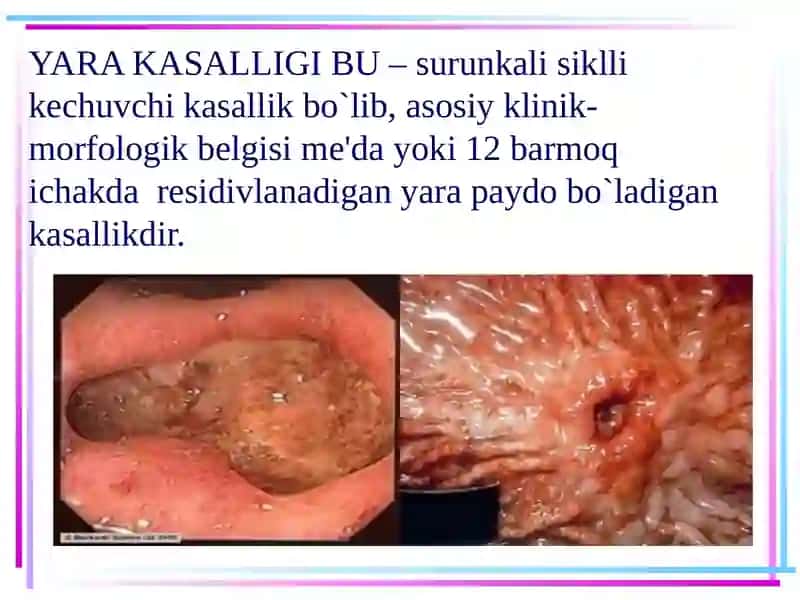 Me’da va 12 barmoqli ichak yara kasalligi 2