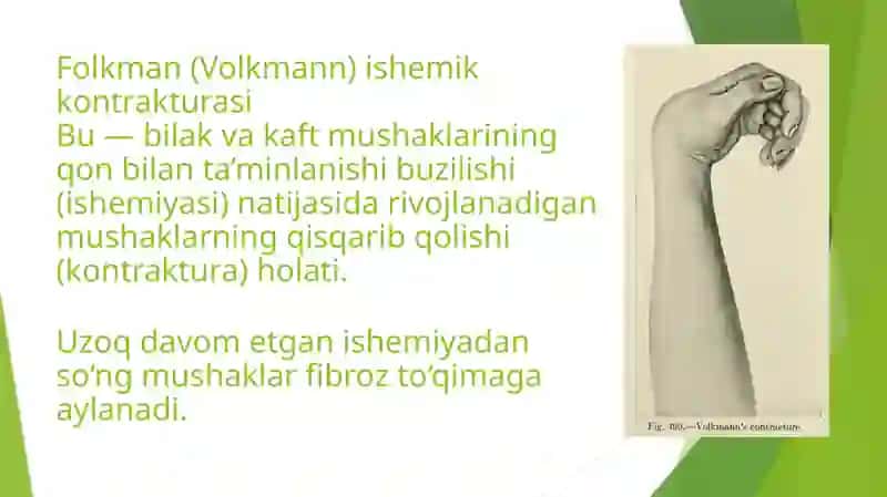 Folkman(Volkmann) ishemik kontrakturasi 2
