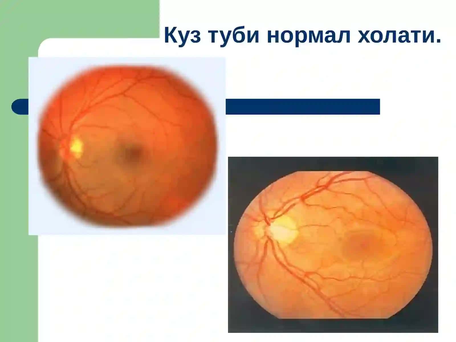 Умумий касалликларда кўз тубидаги ўзгаришлар 2