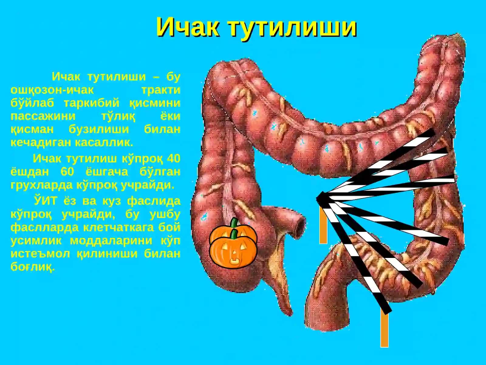 Ўткир ичак тутилиши 2