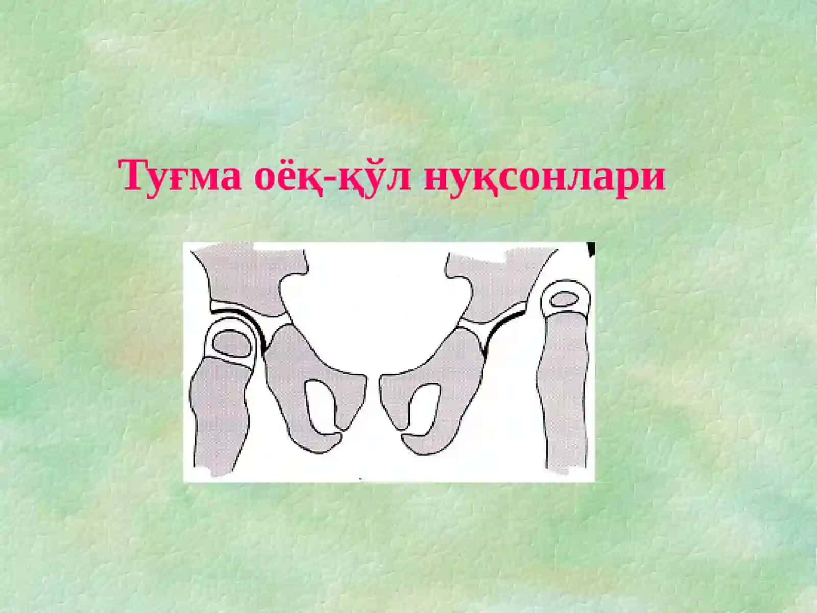 Туғма оёқ-қўл нуқсонлари 2