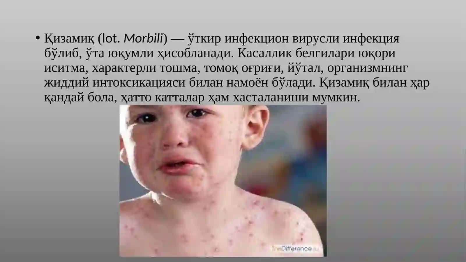 Қизамиқ (MORBILLI) 2