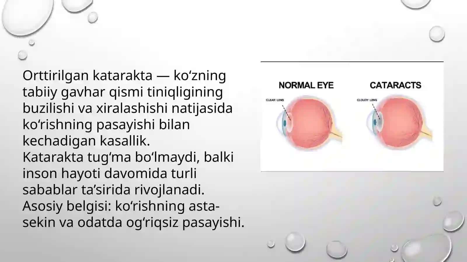 ORTTIRILGAN KATARAKTA 2