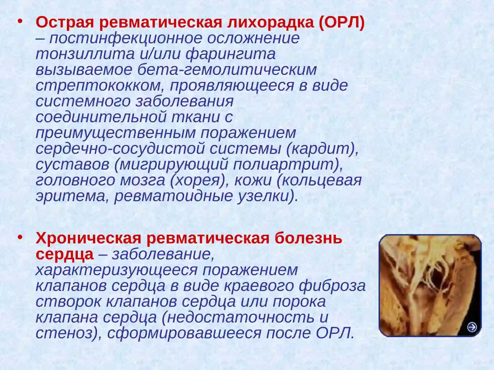 Острая ревматическая лихорадка 2