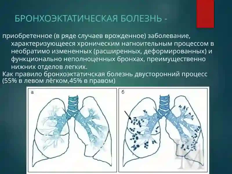 БРОНХОЭКТАТИЧЕСКАЯ БОЛЕЗНЬ 2