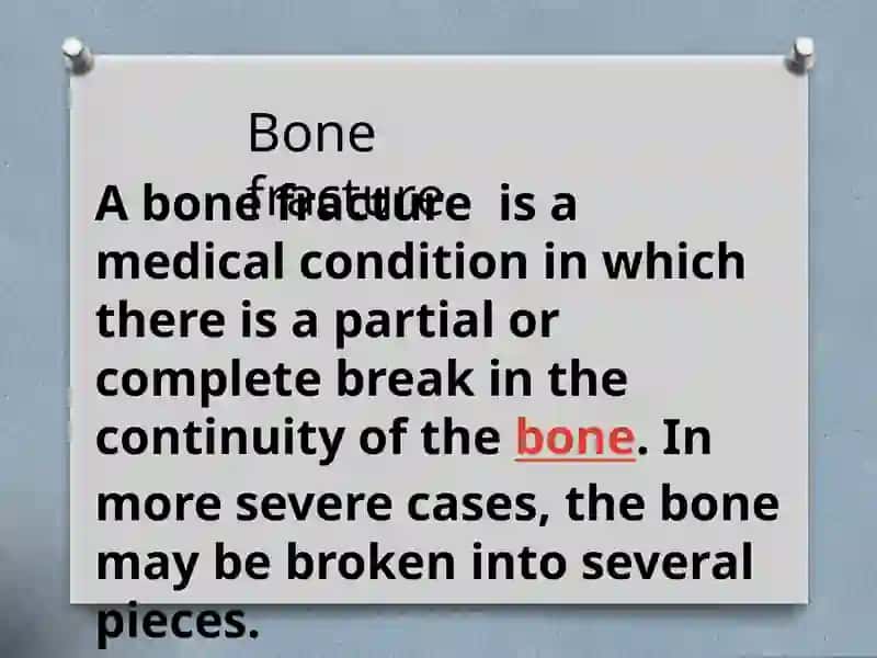 Bone fracture 2