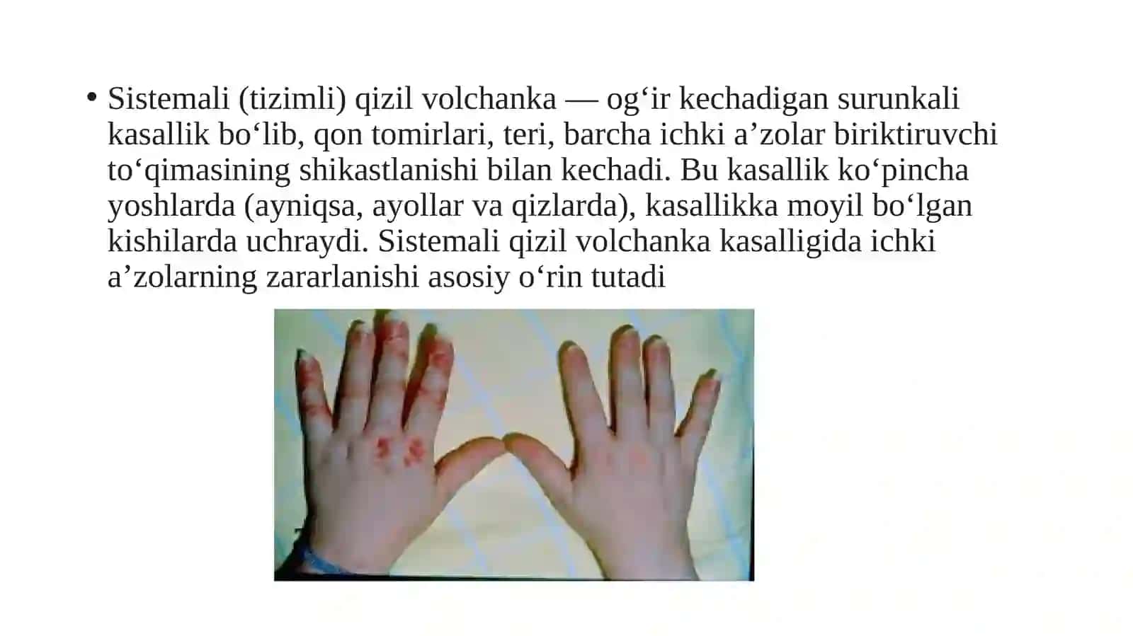Tizimli qizil volchanka 2