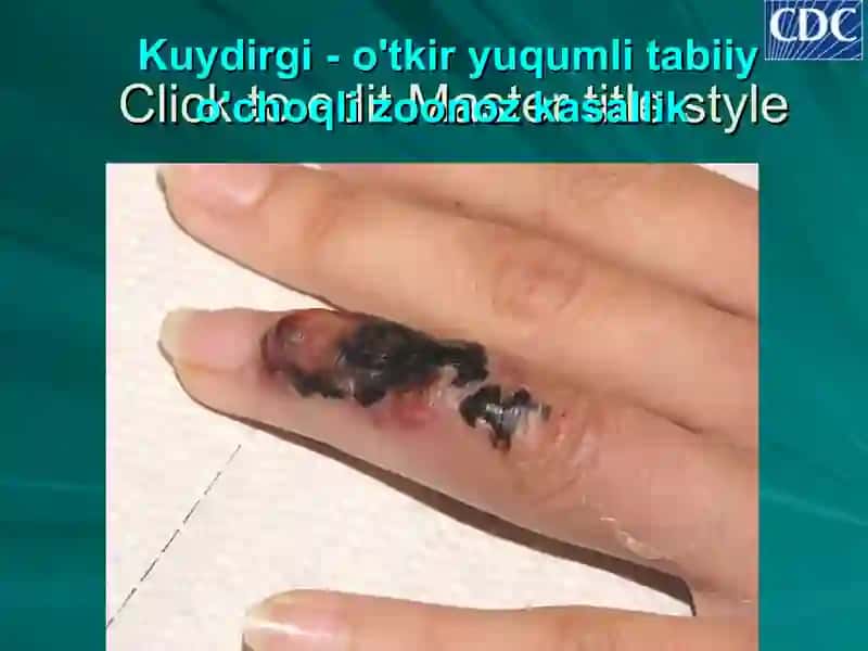 Kuydirgi (sibir yarаsi, yomоn sifаtli kаrbunkul) 2