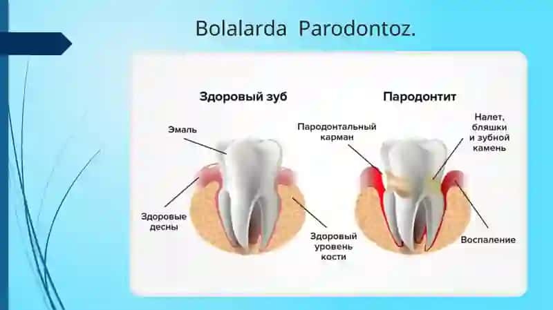 Parodontoz va uning sabablari 2