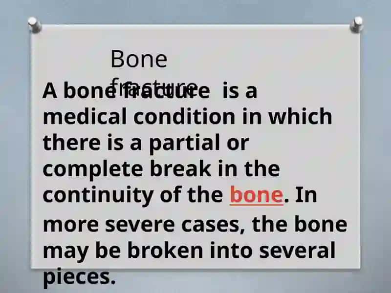 Bone fracture 2