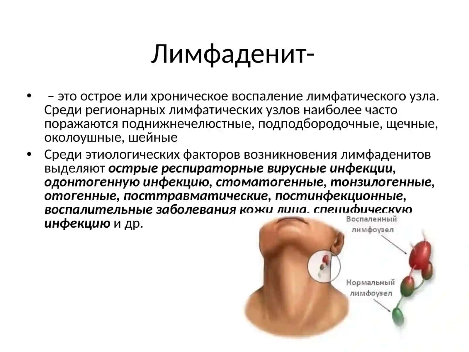 Лимфадениты челюстно-лицевой области 2