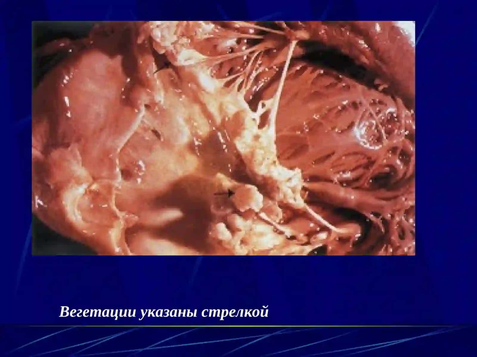 ИНФЕКЦИОННЫЙ ЭНДОКАРДИТ 2