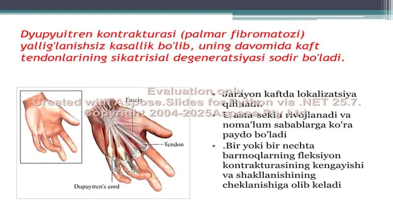 Dyupyuitren kontrakturasi 2