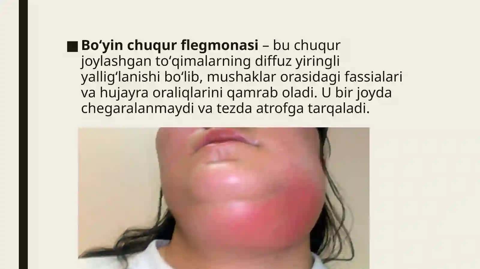Boʻyin chuqur flegmonasi 2
