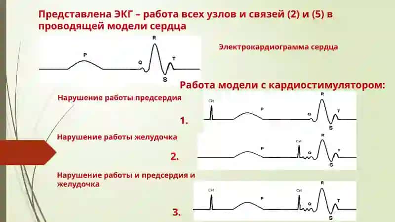 ЭЛЕКТРИЧЕСКАЯ СТИМУЛЯЦИЯ СЕРДЦА 2