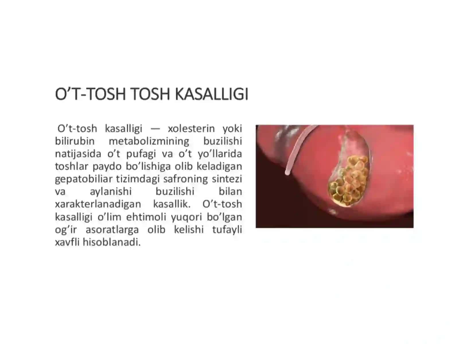 oʻt tosh kasalliklari 2