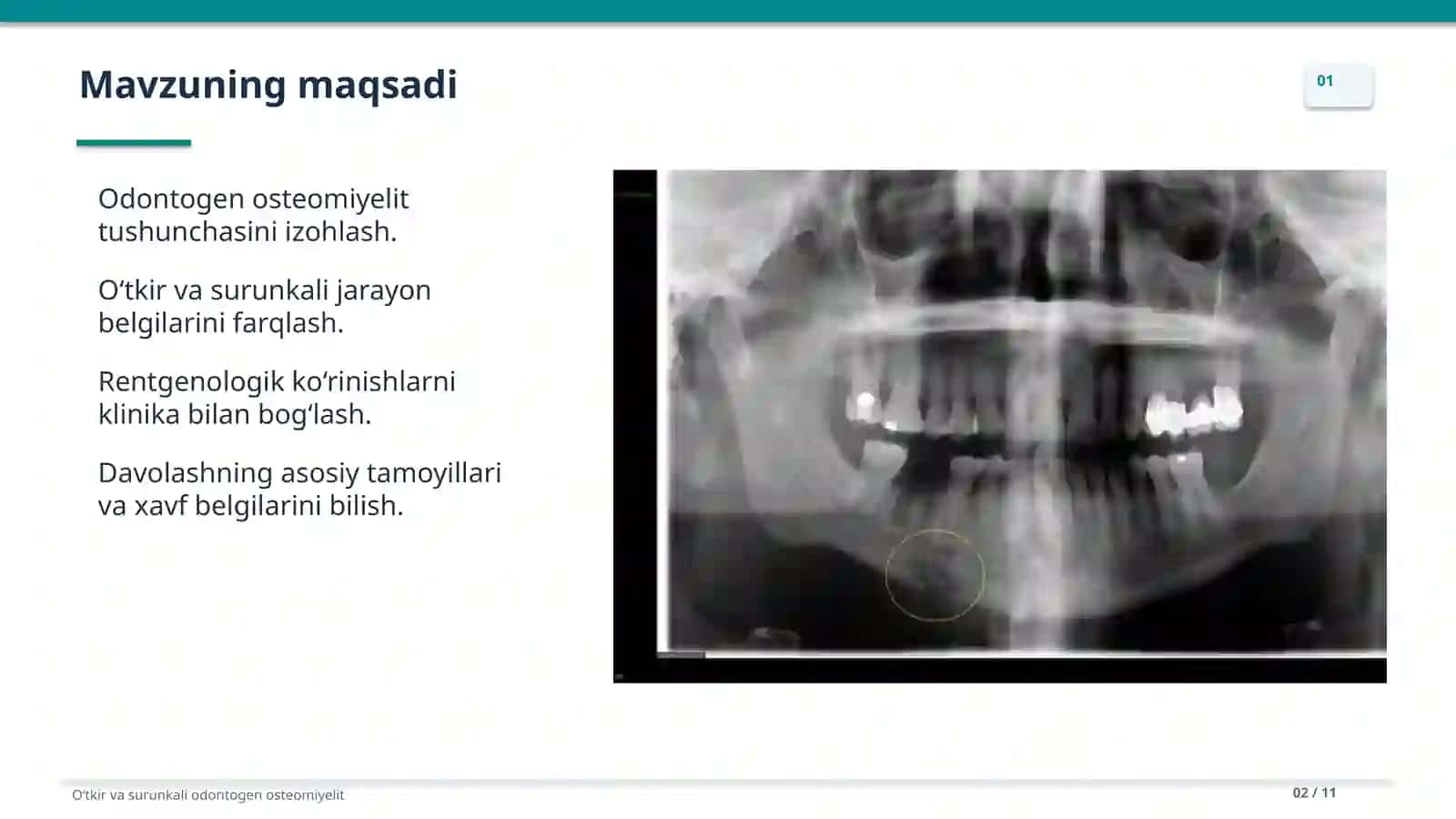 Oʻtkir va surunkali odontogen osteomiyelit 2