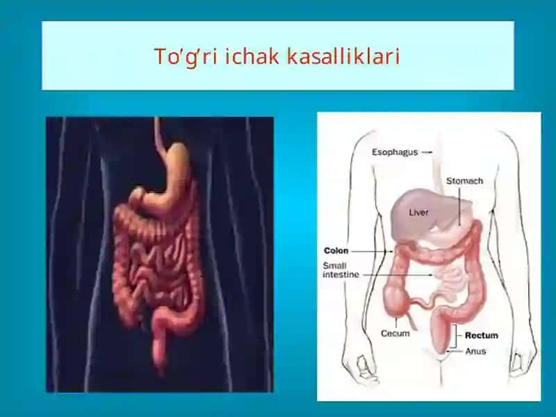To’g’ri ichak kasalliklari 2
