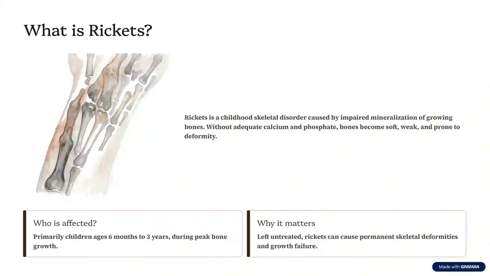 Rickets: Understanding the "Soft Bone" Disease 2