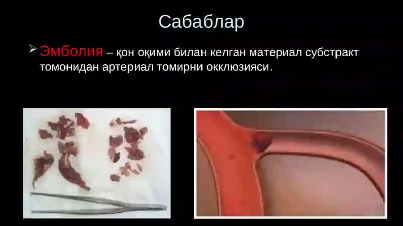 Уткир артериал тутилиш 2