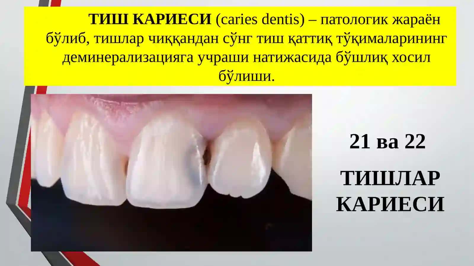 ТИШЛАР КАРИЕСИ 2