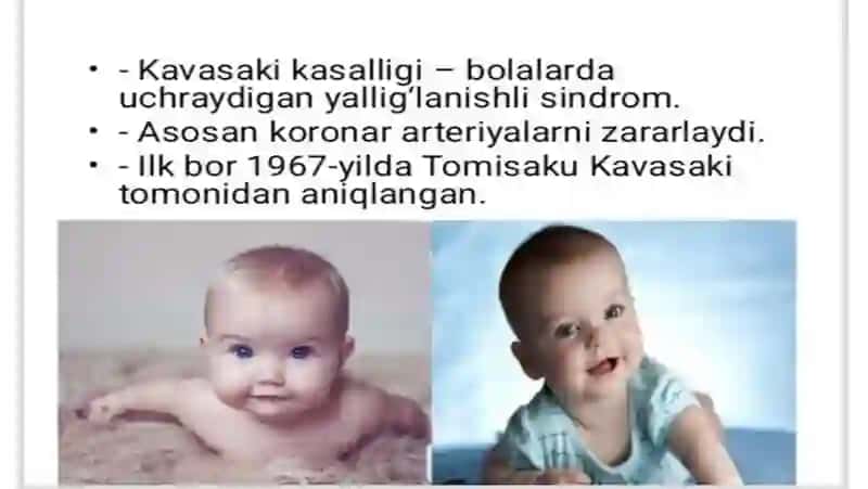 Kavasaki kasalligi 2