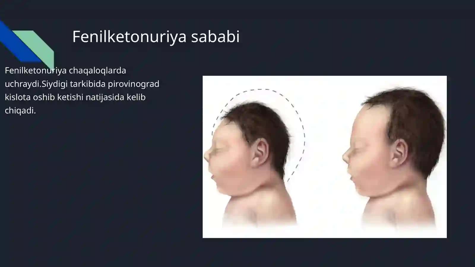 Fenilketonuriya 2