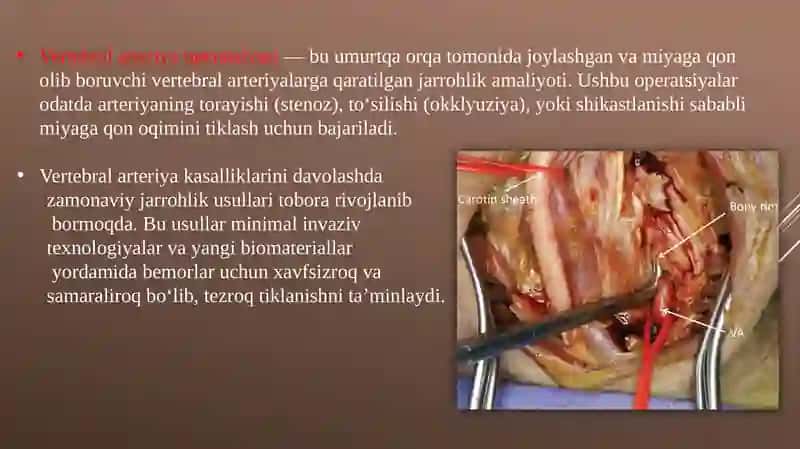 Vertebralarteriya operatsiyasi 2