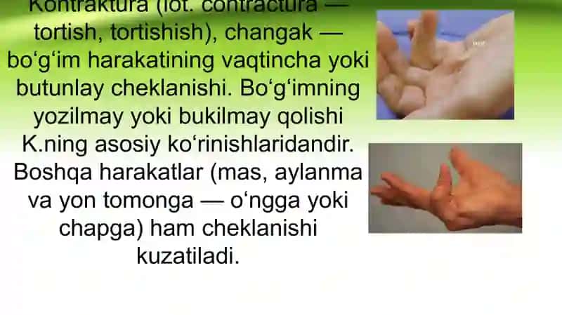 Bo‘g‘imlar kontrakturalari va ankilozlari. Oyoq panjasi statik deformastiyasi. 2