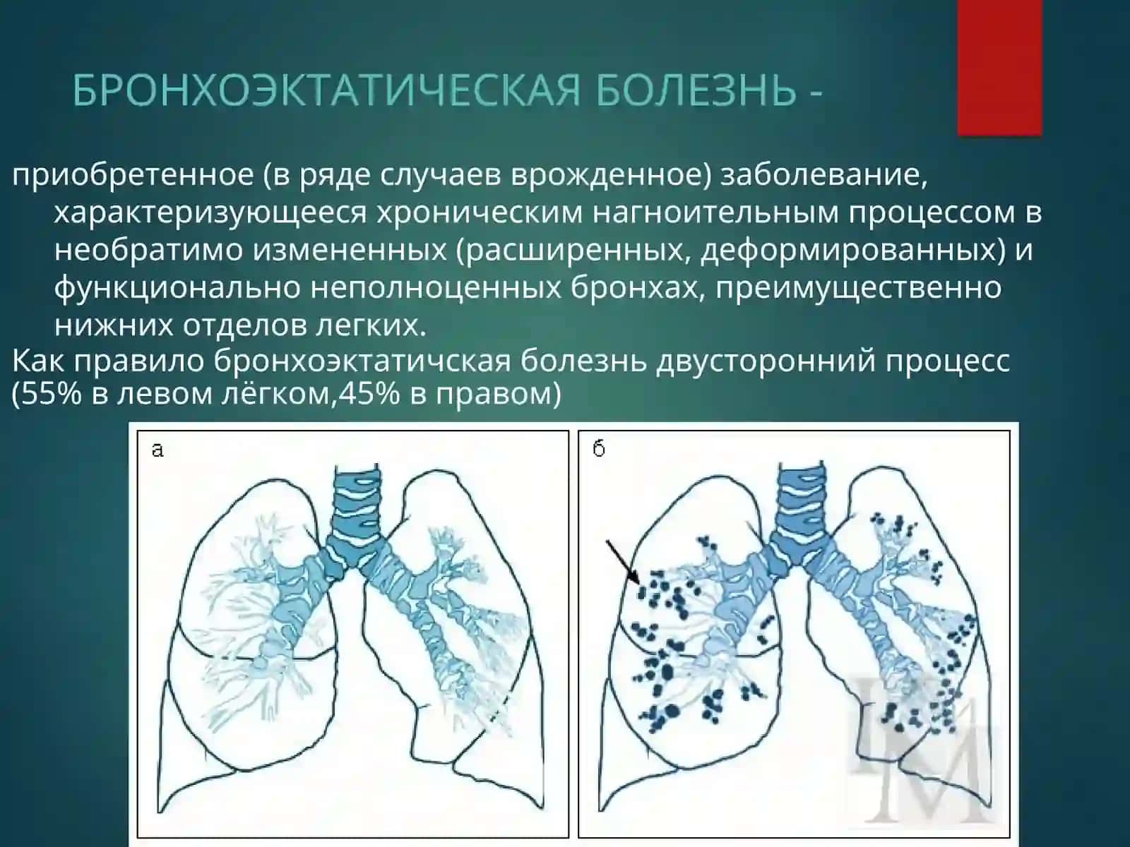 Бронхоэктатическая болезнь 2