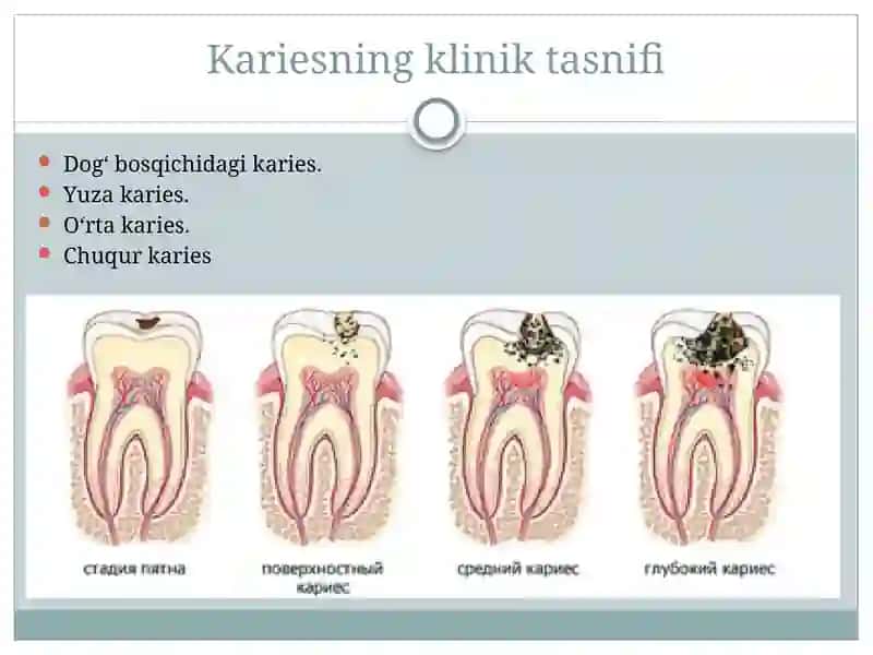 Chuqur karies 2