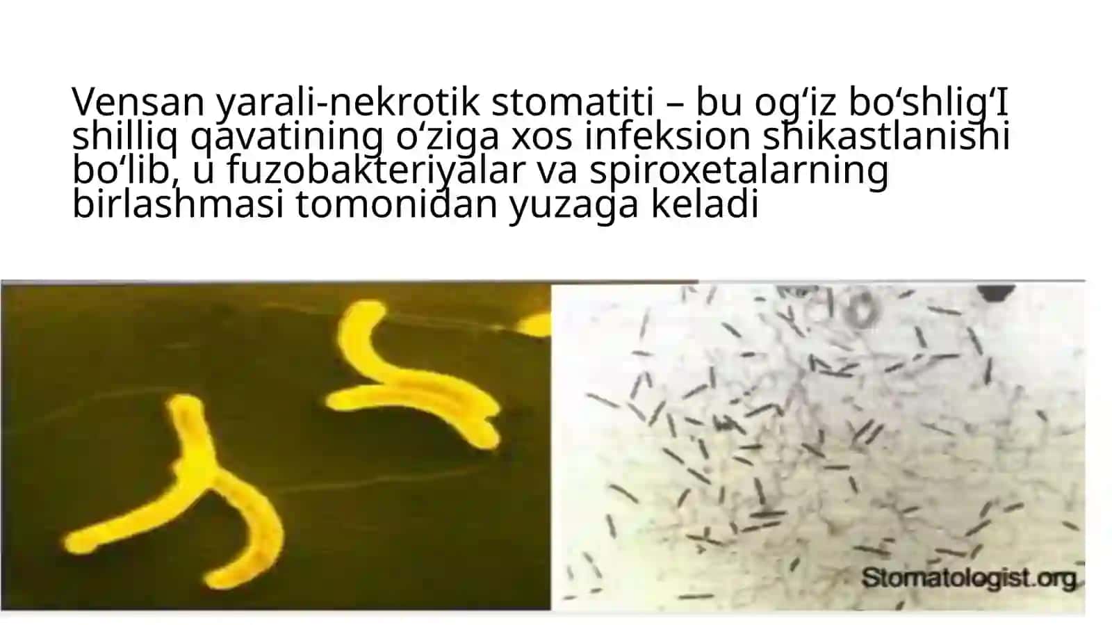 Vensan yarali-nekrotik stomatiti 2
