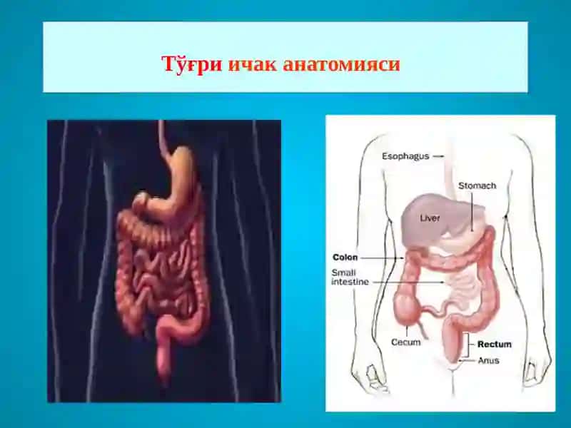 ТЎҒРИ ИЧАК КАСАЛЛИКЛАРИ 2