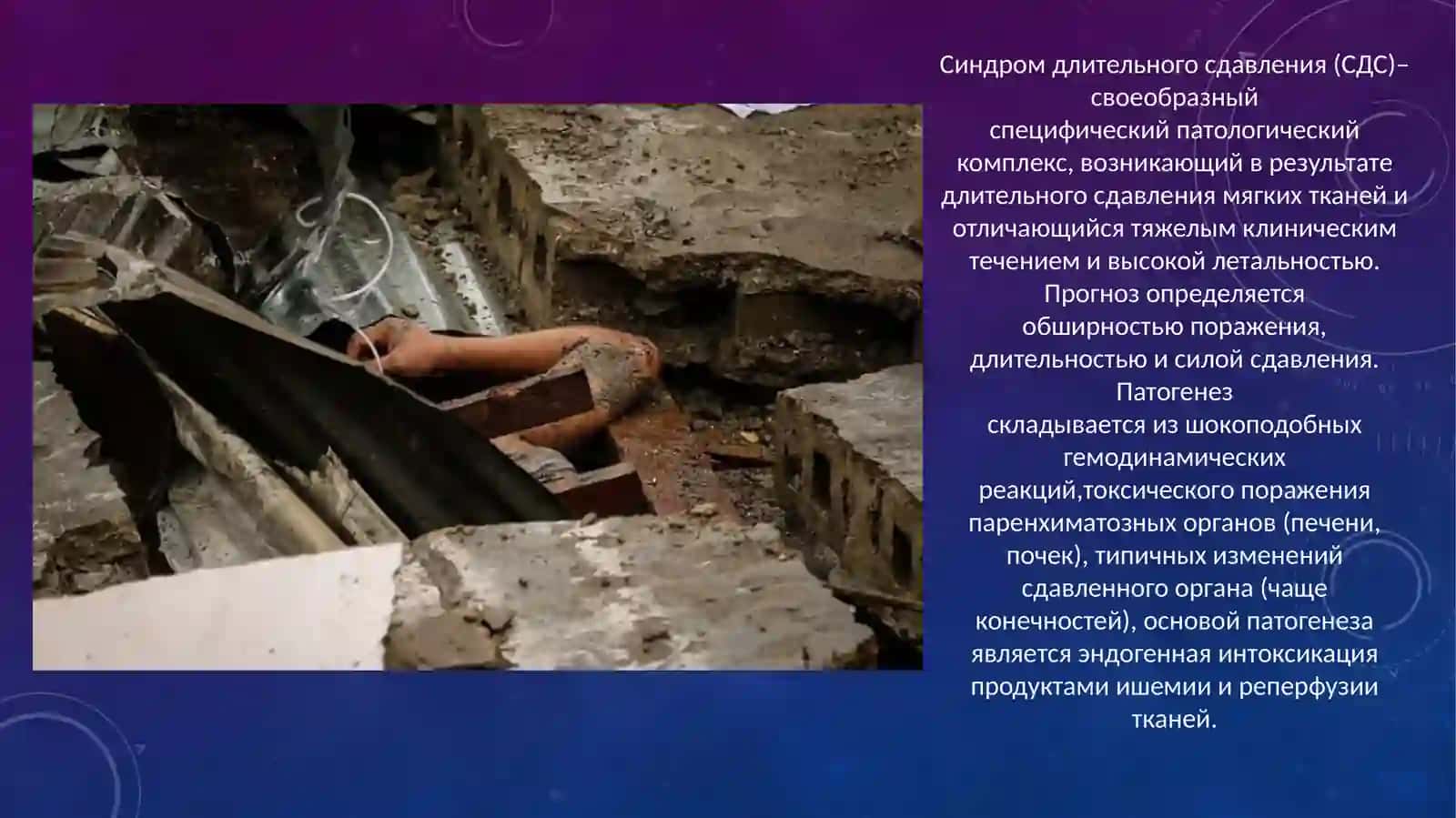 Синдром длительного сдавления (СДС) 2