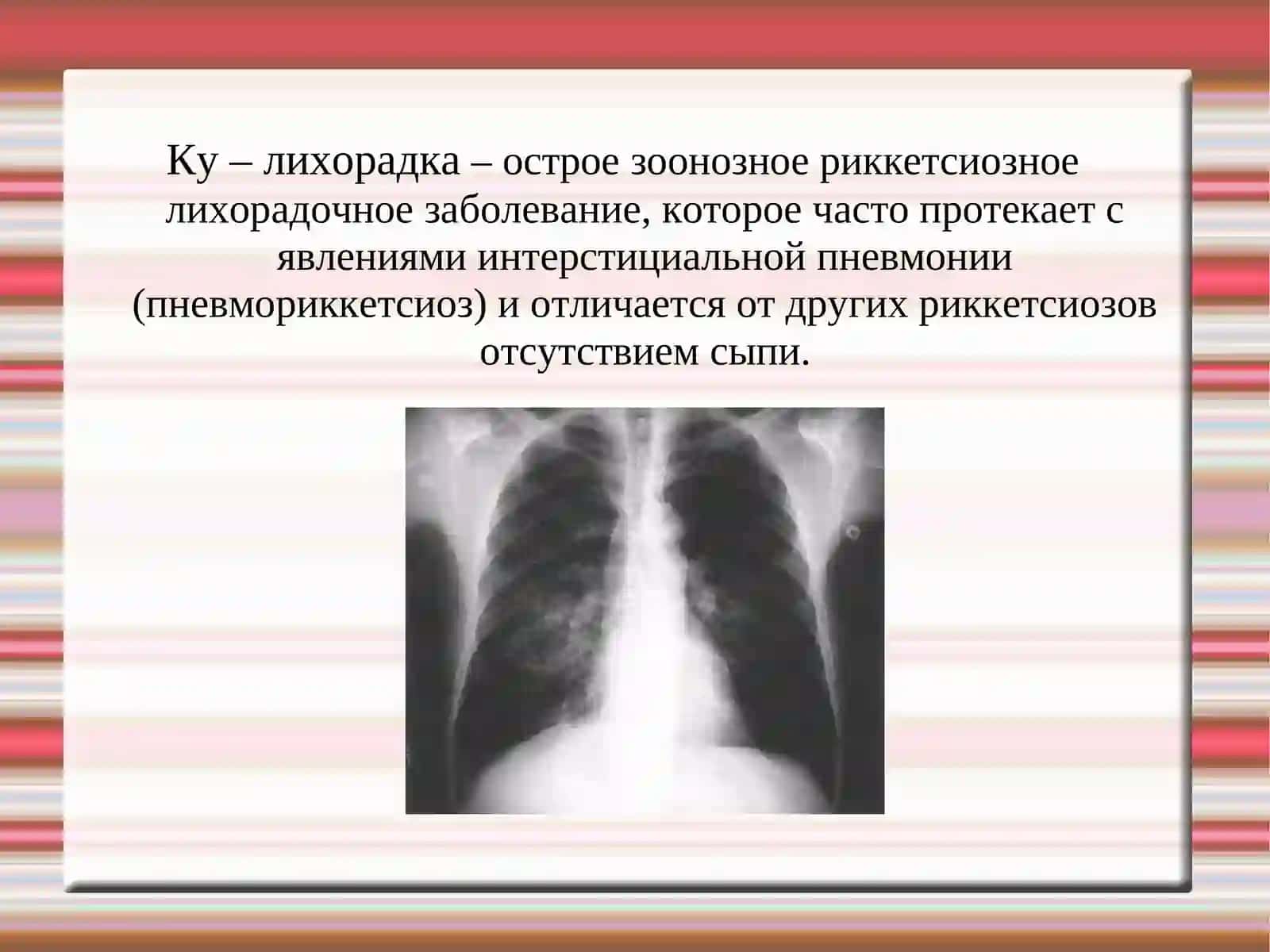 Ку-лихорадка (Q-лихорадка) 2