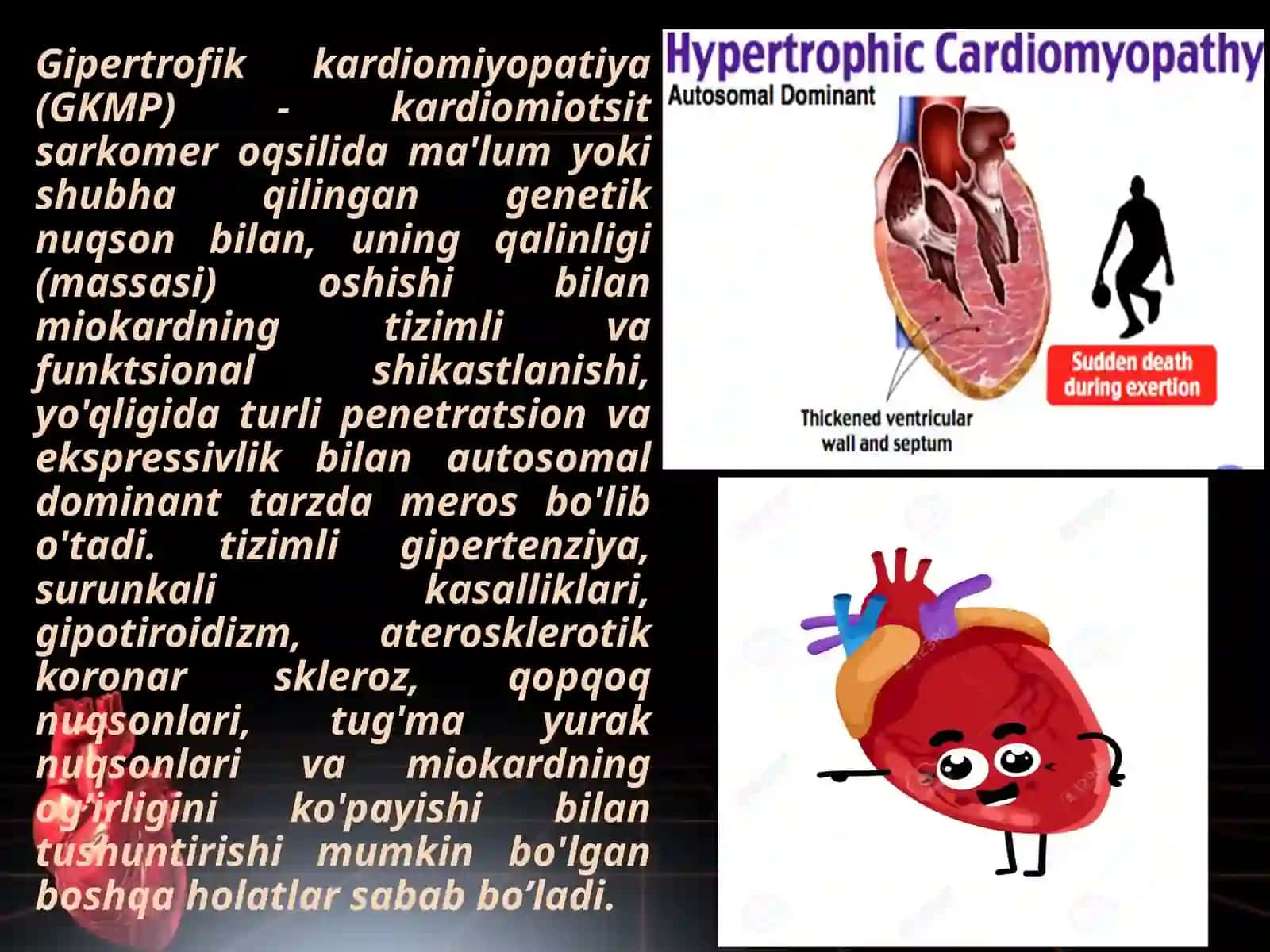 Gipertrofik kardiomiyopatiya 2