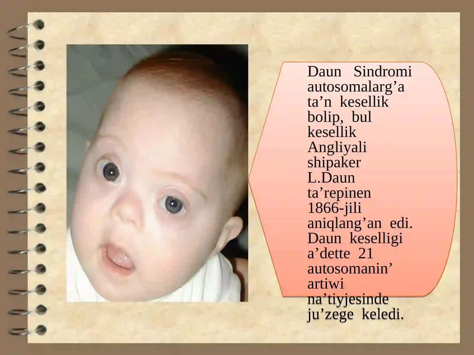 Xromosoma kesellikleri, Daun sindromi 2
