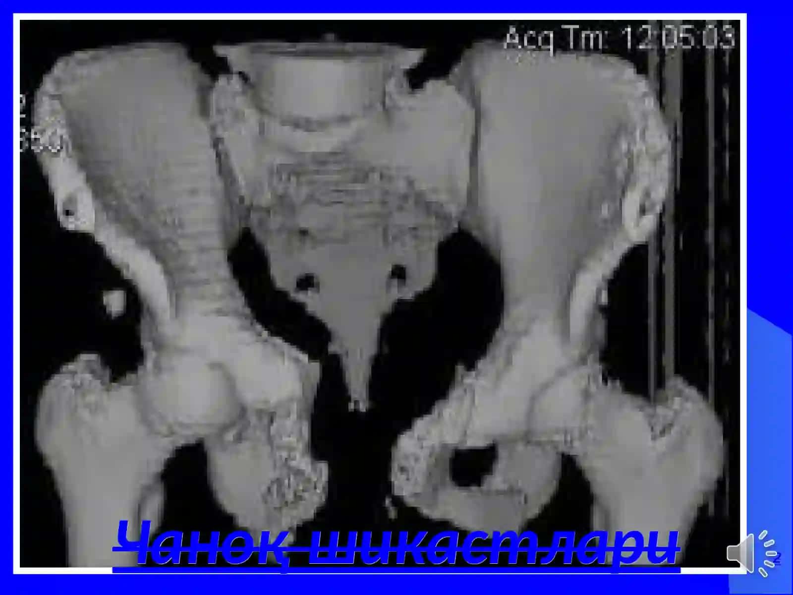 Чаноқ шикастлари 2