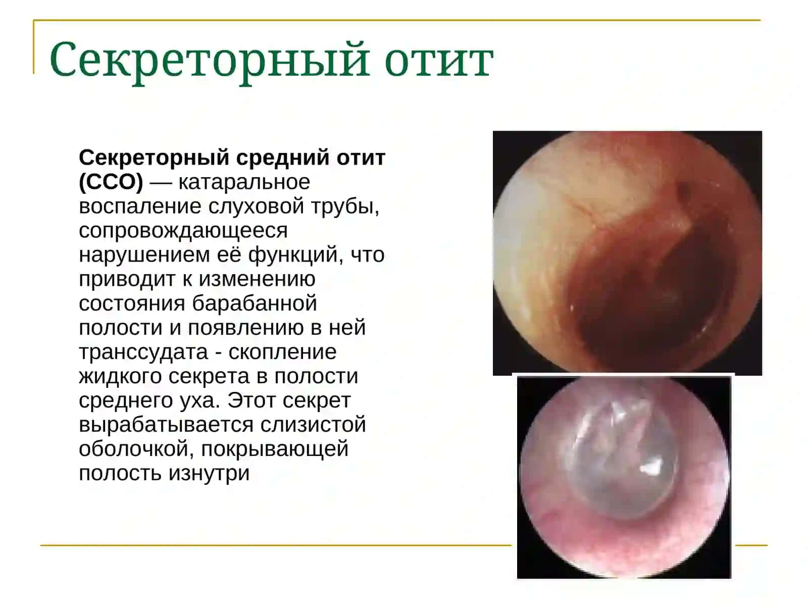Негнойные заболевания уха 2