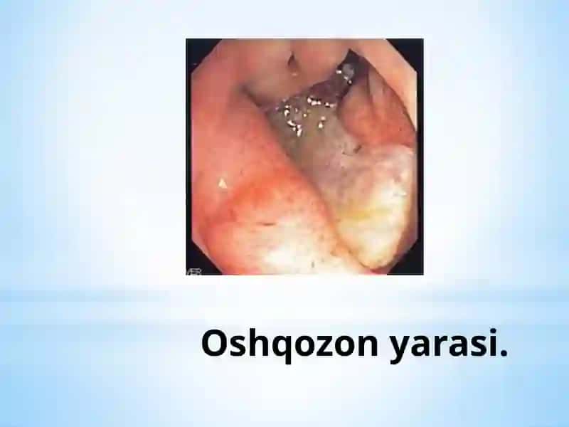 Oshqozonyarakasalligiepiopatogenezi 2